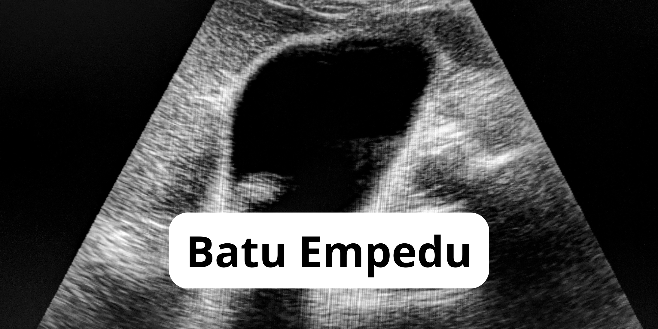 Mitos dan Fakta Makanan Penghancur Batu Empedu